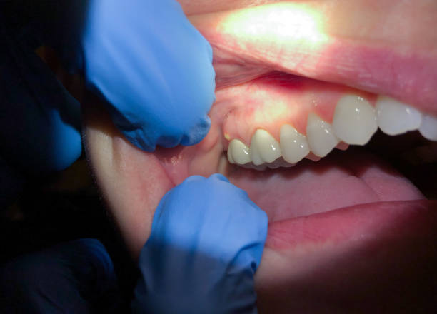 Best Emergency Treatment for Oral Infections in Pleasant Hill, MS